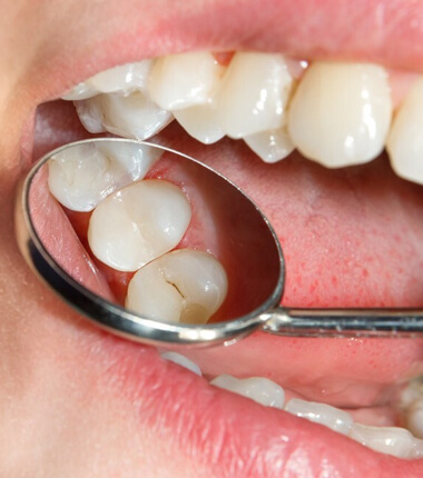 dental sealants in glendale az